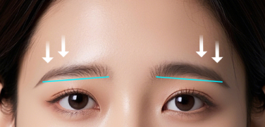 Sagging eyebrows that give a tired look