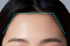 Angular forehead line