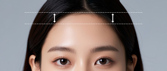 Forehead Reduction and Hairline Correction