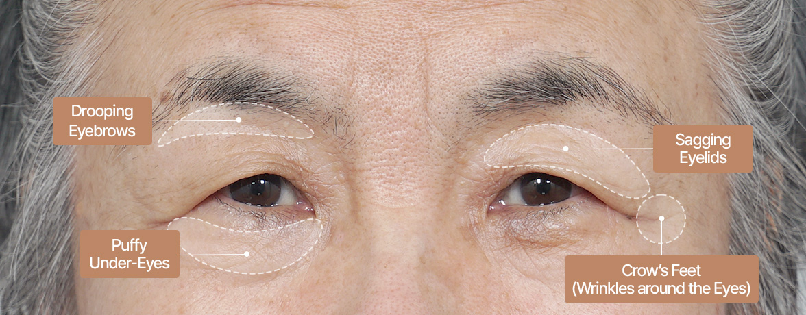 중년 눈성형