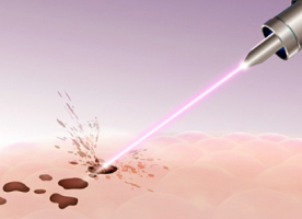 Scar Laser